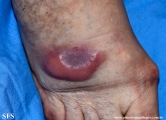 Cutaneous B-cell_lymphoma
