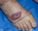 Cutaneous B-cell_lymphoma