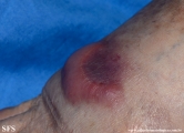 Cutaneous B-cell_lymphoma