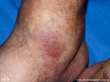 Cutaneous B-cell_lymphoma
