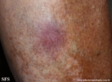 Cutaneous B-cell_lymphoma