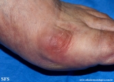 Cutaneous B-cell_lymphoma