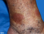 Cutaneous B-cell_lymphoma