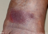 Cutaneous B-cell_lymphoma