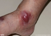 Cutaneous B-cell_lymphoma