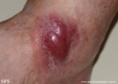 Cutaneous B-cell_lymphoma