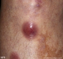 Cutaneous B-cell_lymphoma