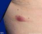 Cutaneous B-cell_lymphoma