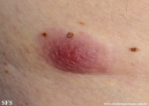 Cutaneous B-cell_lymphoma