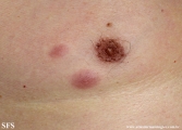 Cutaneous B-cell_lymphoma
