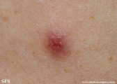 Cutaneous B-cell_lymphoma
