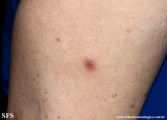 Cutaneous B-cell_lymphoma