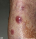 Cutaneous B-cell_lymphoma