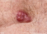 Cutaneous B-cell_lymphoma