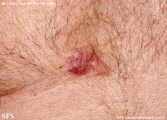 Cutaneous B-cell_lymphoma