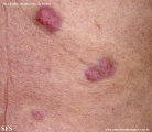 Cutaneous B-cell_lymphoma