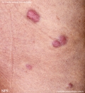 Cutaneous B-cell_lymphoma