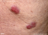 Cutaneous B-cell_lymphoma
