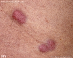 Cutaneous B-cell_lymphoma