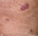 Cutaneous B-cell_lymphoma