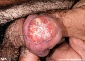 squamous cell carcinoma