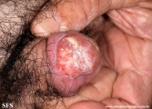 squamous cell carcinoma