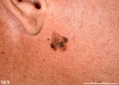 lentigo maligna-melanoma