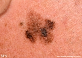 lentigo maligna-melanoma