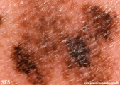 lentigo maligna-melanoma