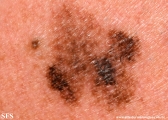 lentigo maligna-melanoma