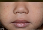 acrodermatitis infantile papular