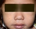 acrodermatitis infantile papular