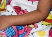 acrodermatitis infantile papular