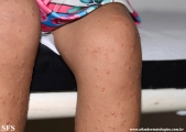 acrodermatitis infantile papular