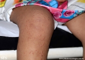 acrodermatitis infantile papular