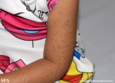 acrodermatitis infantile papular