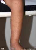 acrodermatitis infantile papular