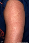 keratosis pilaris