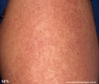 keratosis pilaris