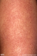 keratosis pilaris