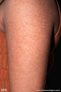 keratosis pilaris