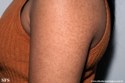 keratosis pilaris