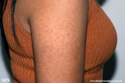 keratosis pilaris