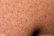 keratosis pilaris