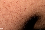 keratosis pilaris