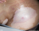 vitiligo_and_morphea