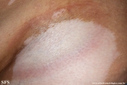 vitiligo_and_morphea