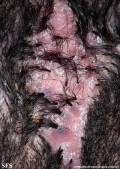 folliculitis decalvans