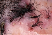 folliculitis decalvans