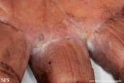 candidiasis